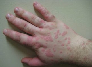 Tackling Valley Fever in California