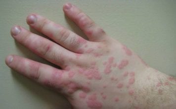 Tackling Valley Fever in California