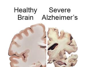 Alzheimer’s San Diego Presents ‘Memory Loss 101’