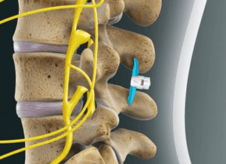 Boston Scientific Acquires Carlsbad’s Vertiflex for $465M Upfront