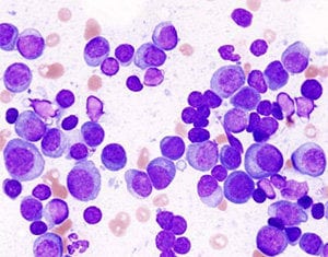 Multiple Myeloma Research Laboratory at Moores Cancer Center Seeks Charitable Donations