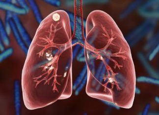 County Initiative Selected as National TB Elimination Champion