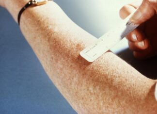 Active Tuberculosis Reported at California State University San Marcos