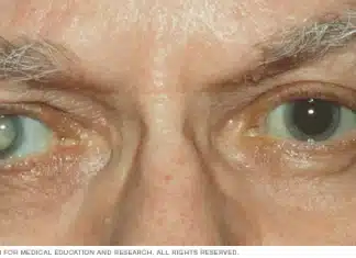 Protecting Your Vision with Vista Community Clinic